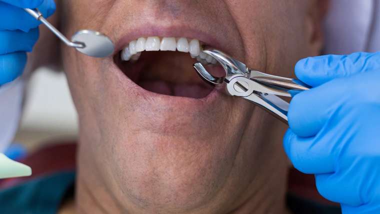 Root Canal Treatment | Lambton Dental